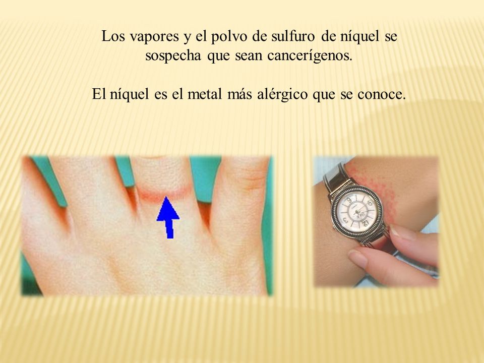El níquel es el metal más alérgico que se conoce.