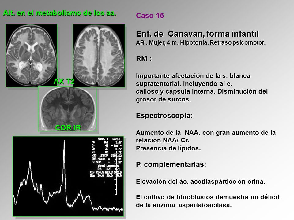 Enf. de Canavan, forma infantil