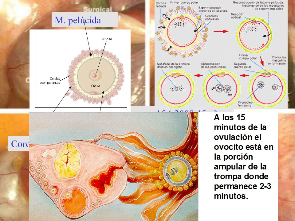 M. pelúcida Jacques Donnez 15 ‘ 2008,45 años M. plasmática Corona radiada