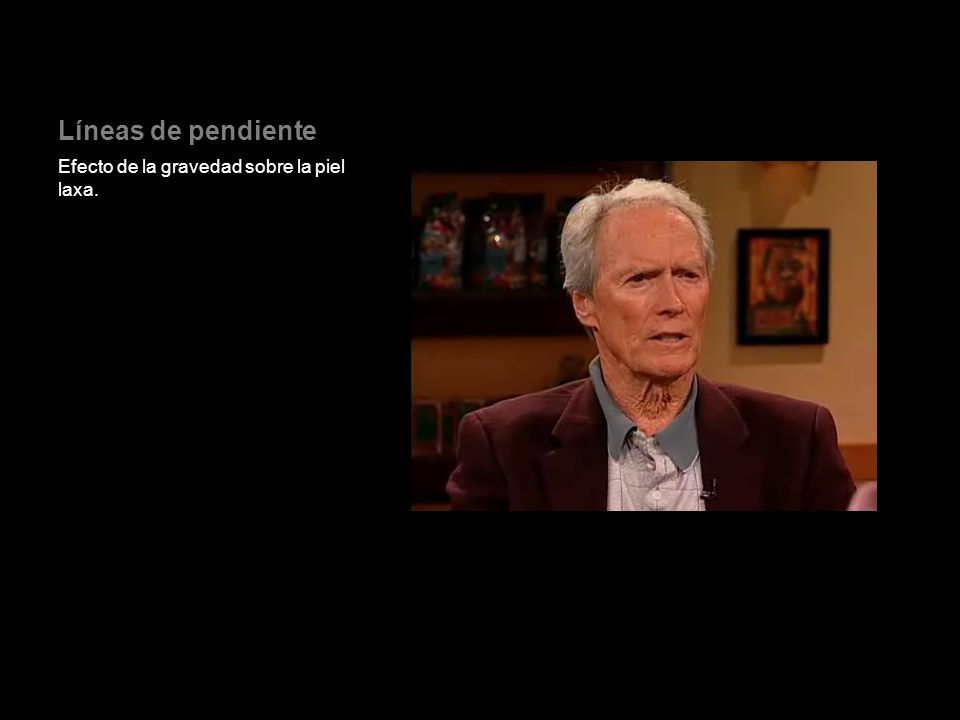 Líneas de pendiente Efecto de la gravedad sobre la piel laxa.