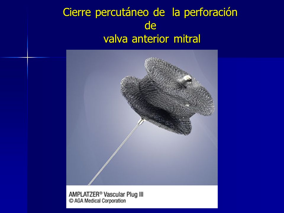 Cierre percutáneo de la perforación de valva anterior mitral