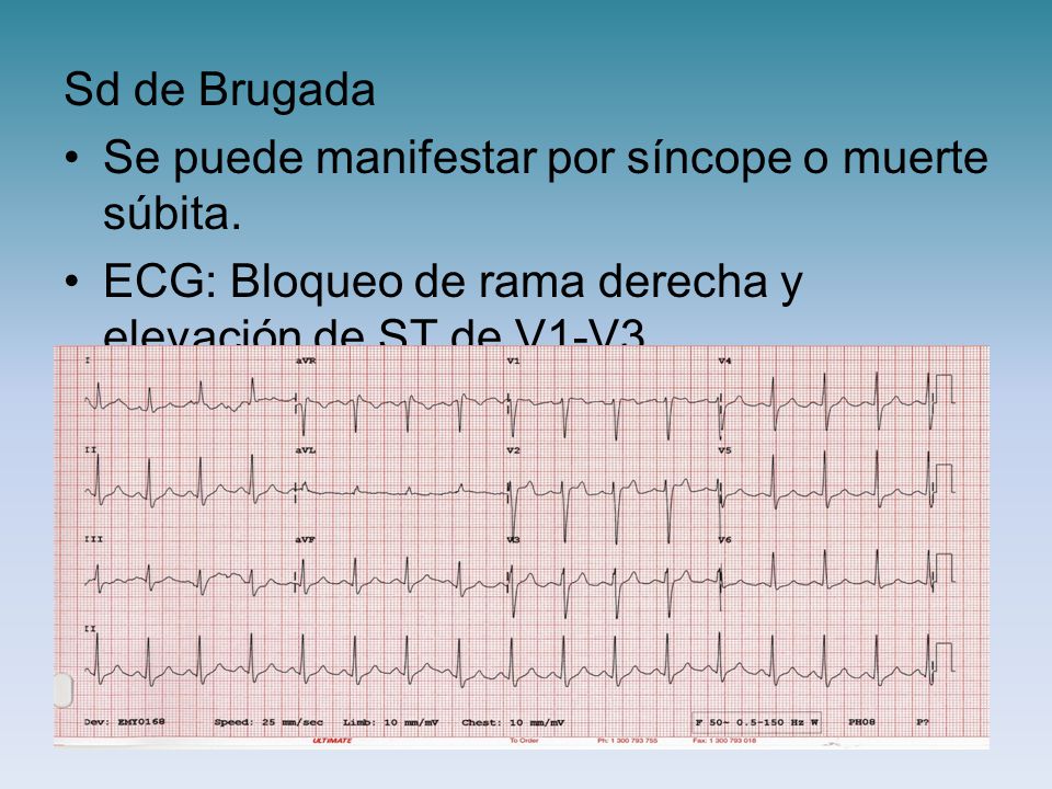 Sd de Brugada Se puede manifestar por síncope o muerte súbita. ECG: Bloqueo de rama derecha y elevación de ST de V1-V3.