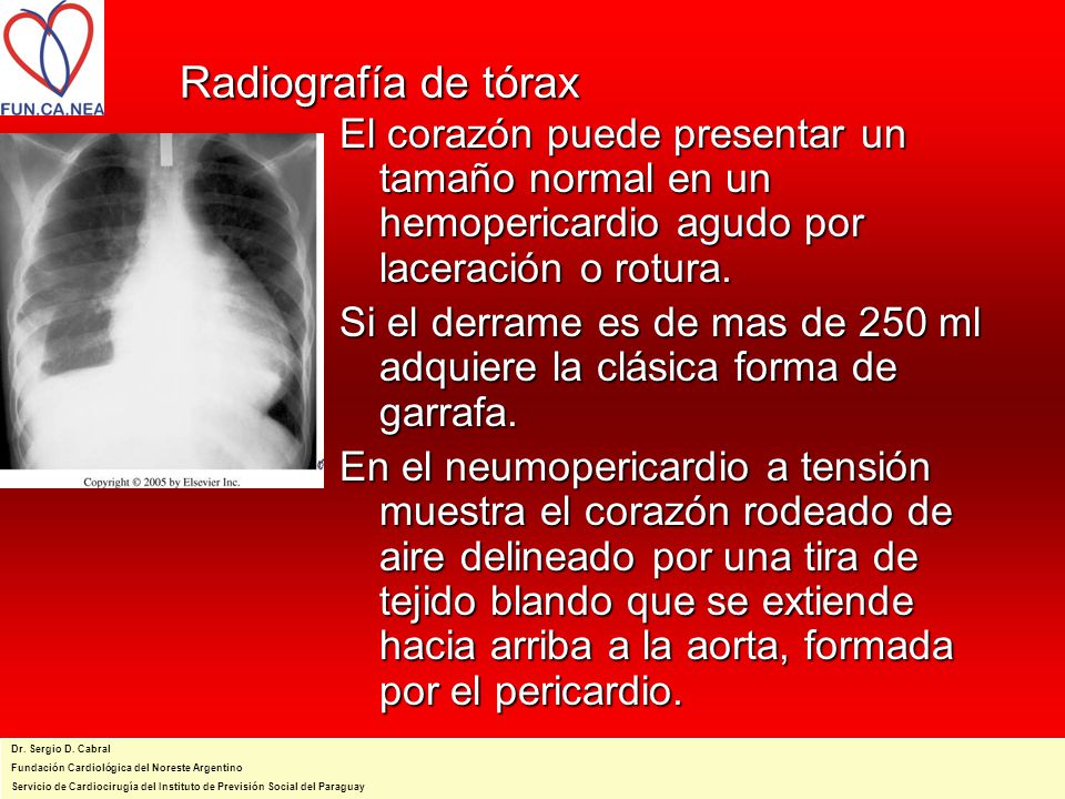 Radiografía de tórax El corazón puede presentar un tamaño normal en un hemopericardio agudo por laceración o rotura.