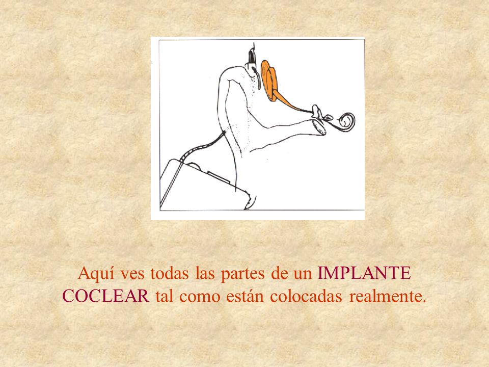 Aquí ves todas las partes de un IMPLANTE COCLEAR tal como están colocadas realmente.