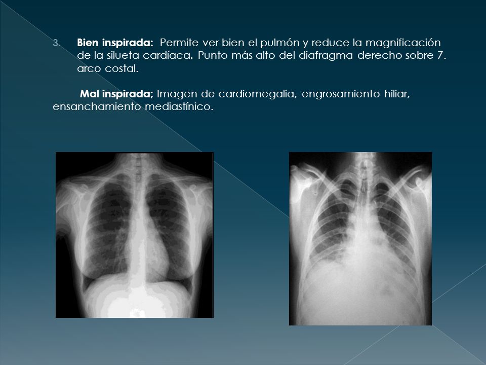Bien inspirada: Permite ver bien el pulmón y reduce la magnificación de la silueta cardíaca. Punto más alto del diafragma derecho sobre 7. arco costal.