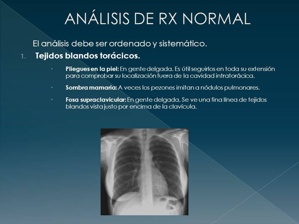 ANÁLISIS DE RX NORMAL El análisis debe ser ordenado y sistemático.