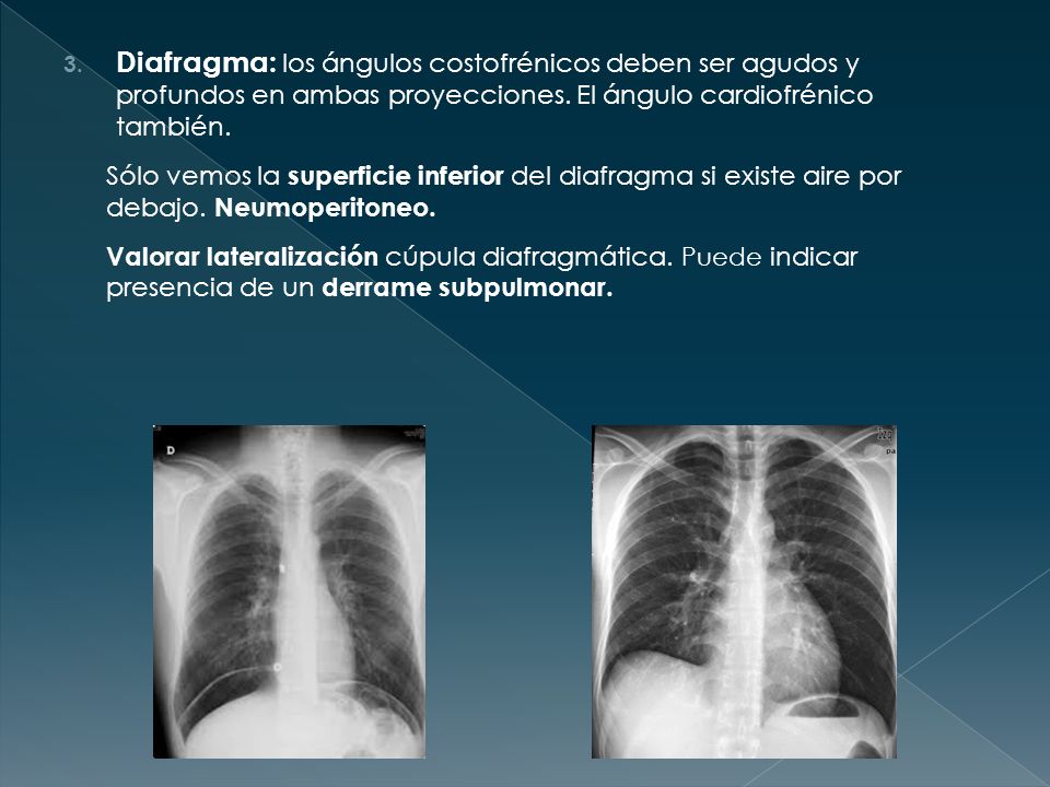 Diafragma: los ángulos costofrénicos deben ser agudos y profundos en ambas proyecciones. El ángulo cardiofrénico también.