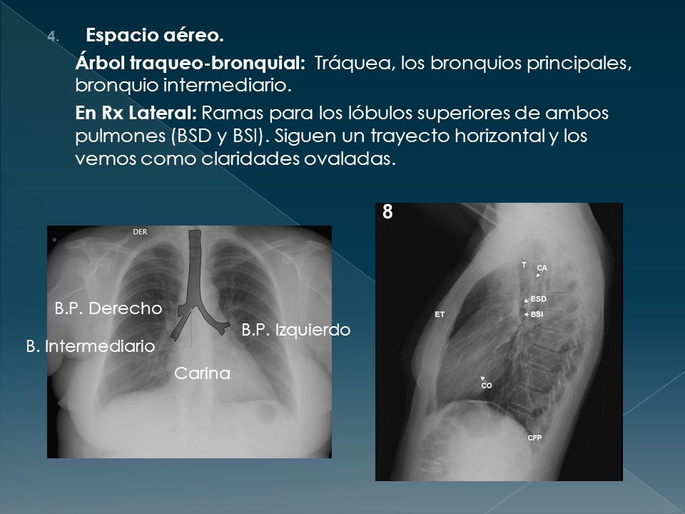 Espacio aéreo. Árbol traqueo-bronquial: Tráquea, los bronquios principales, bronquio intermediario.
