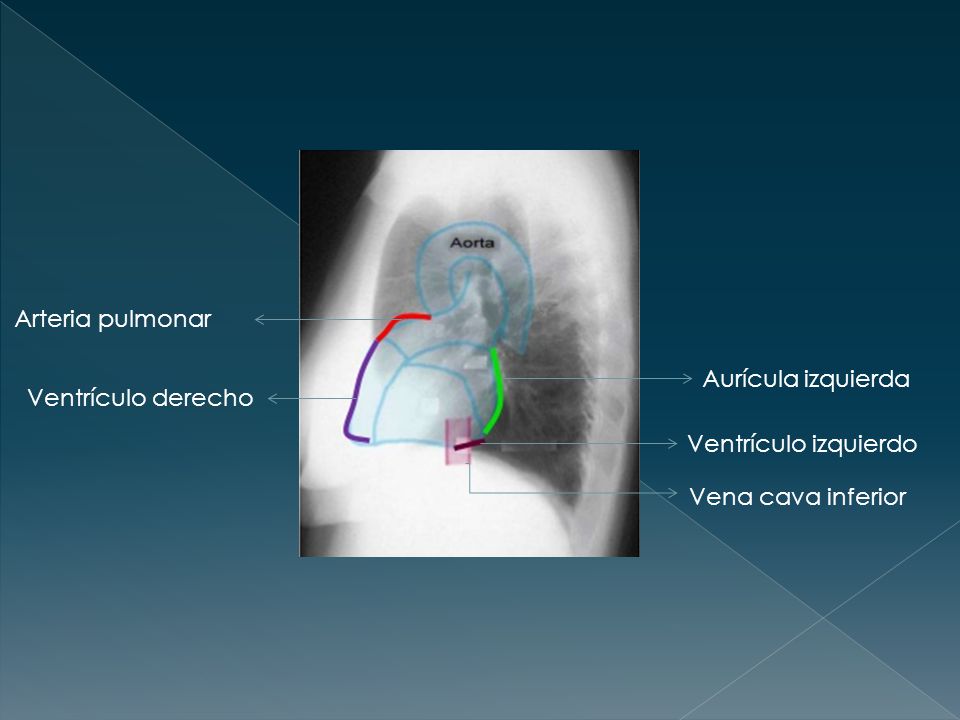 Arteria pulmonar Aurícula izquierda Ventrículo derecho Ventrículo izquierdo Vena cava inferior