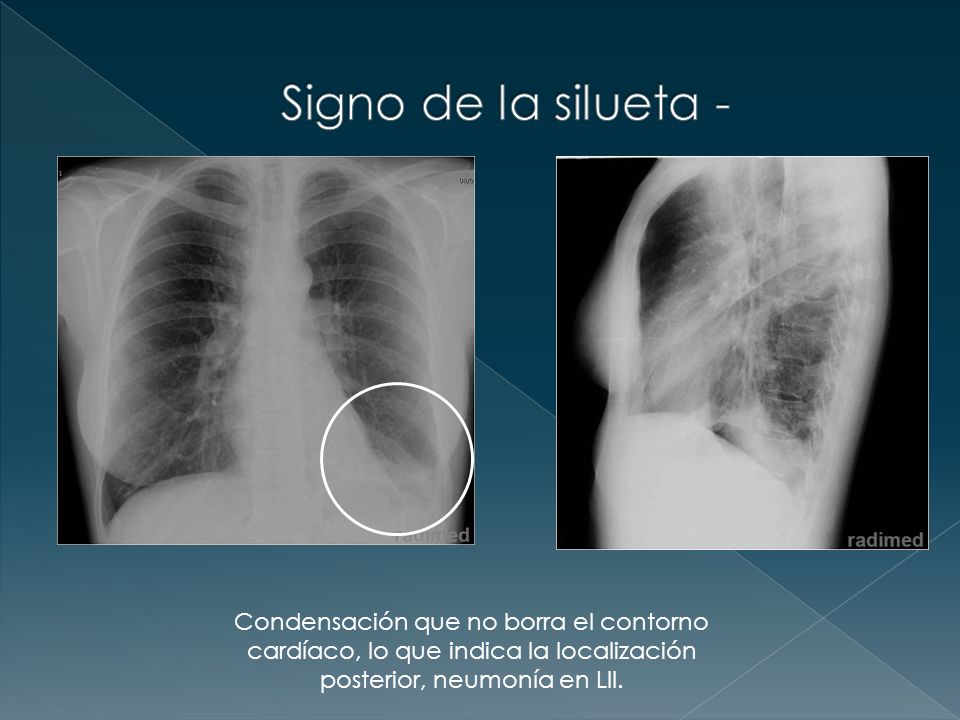 Signo de la silueta - Condensación que no borra el contorno cardíaco, lo que indica la localización posterior, neumonía en LII.