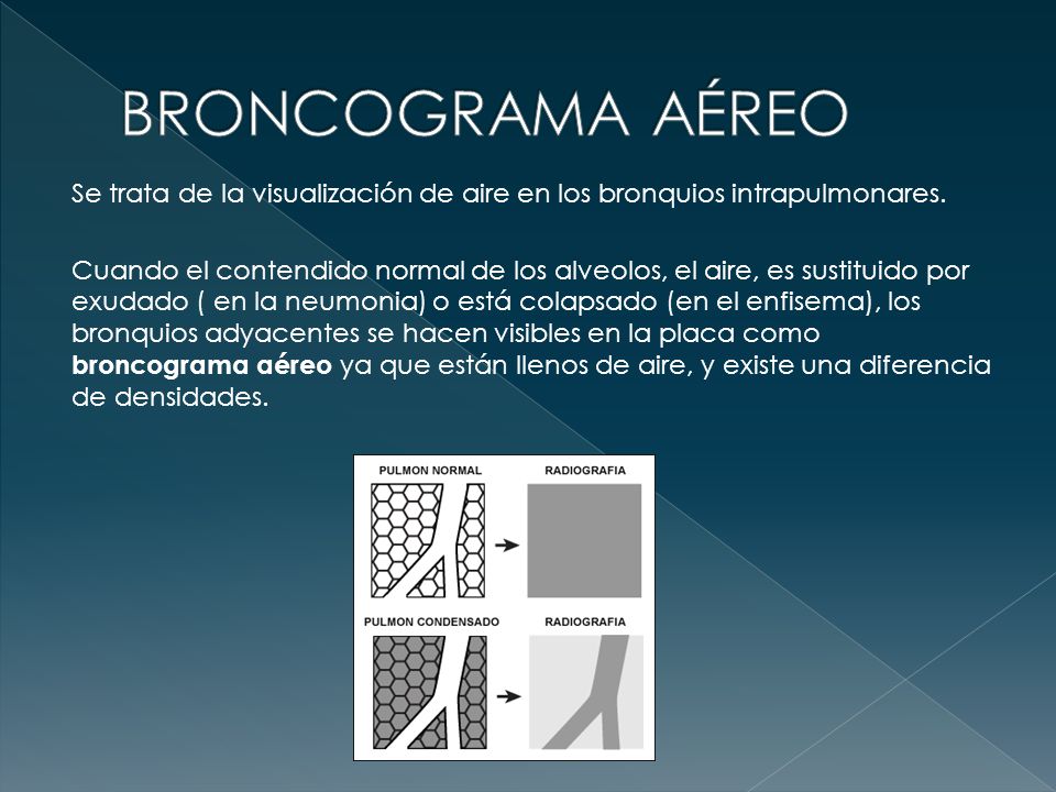 BRONCOGRAMA AÉREO Se trata de la visualización de aire en los bronquios intrapulmonares.