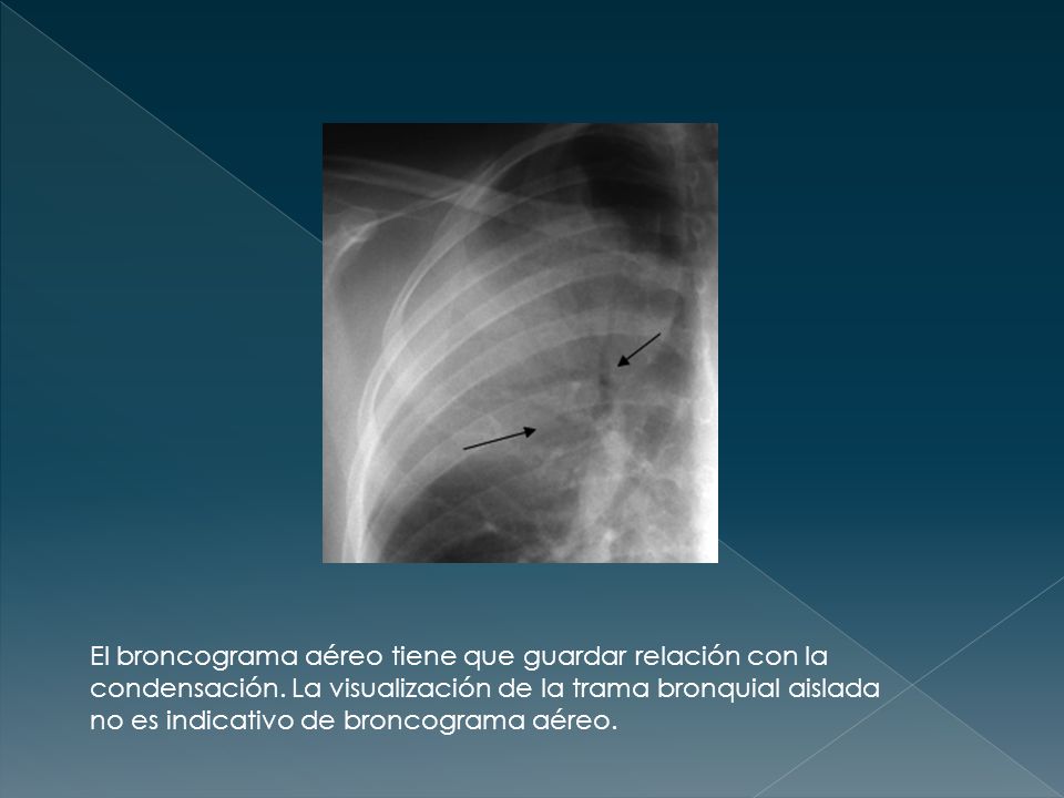El broncograma aéreo tiene que guardar relación con la condensación