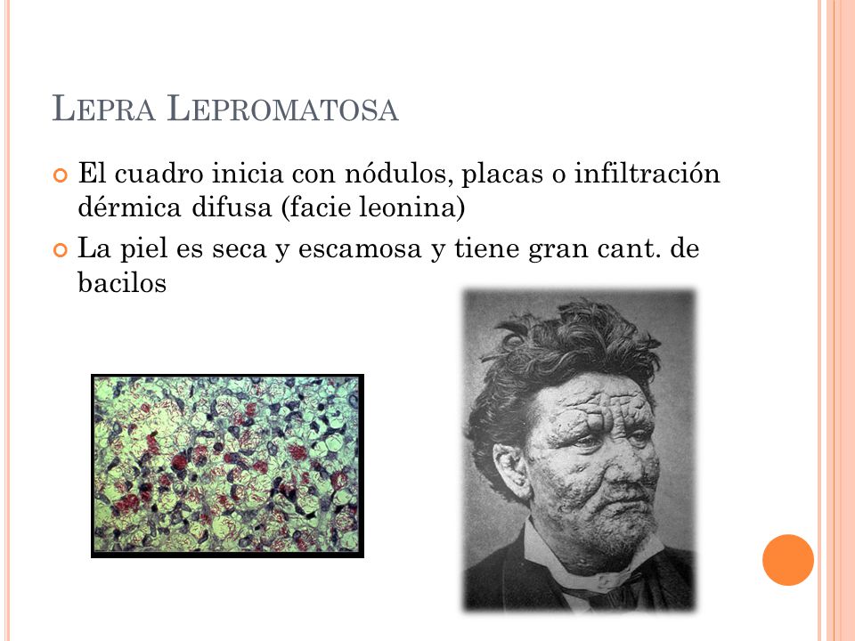 Lepra Lepromatosa El cuadro inicia con nódulos, placas o infiltración dérmica difusa (facie leonina)