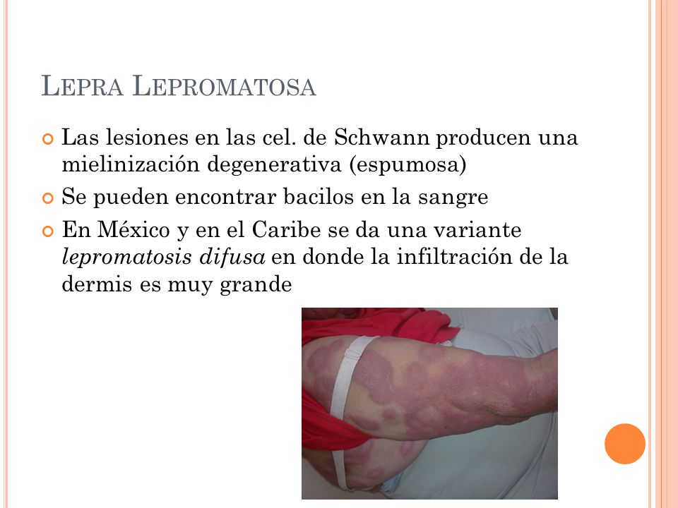 Lepra Enfermedad De Hansen Ppt Descargar