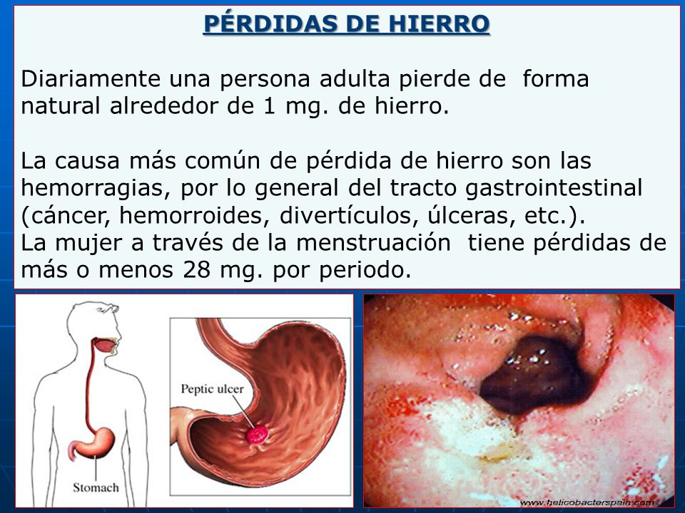 PÉRDIDAS DE HIERRO Diariamente una persona adulta pierde de forma natural alrededor de 1 mg. de hierro.