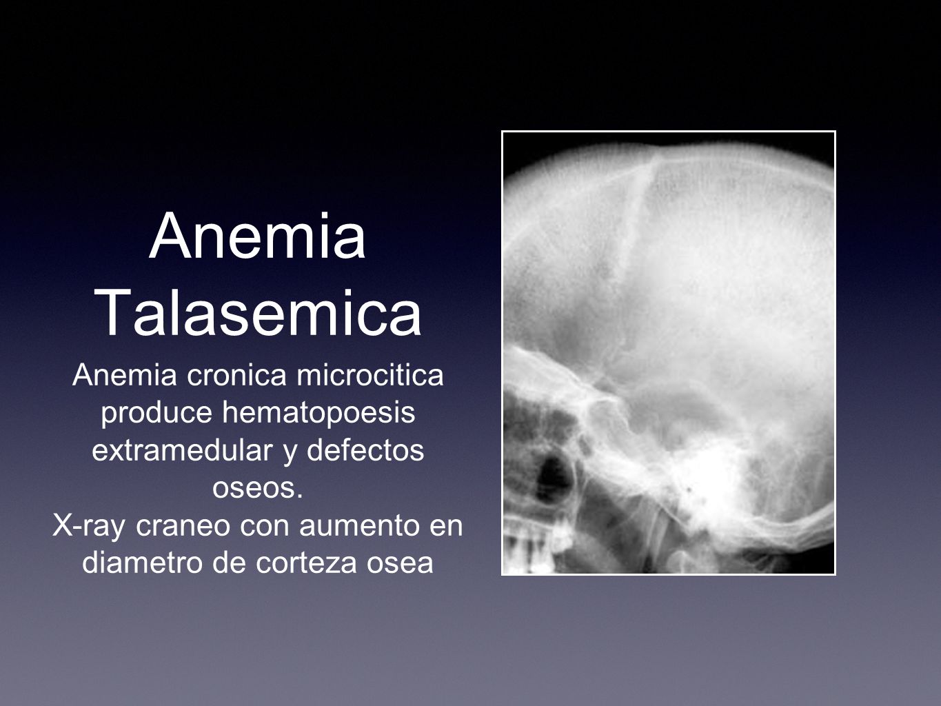 X-ray craneo con aumento en diametro de corteza osea