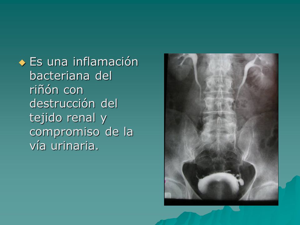 Es una inflamación bacteriana del riñón con destrucción del tejido renal y compromiso de la vía urinaria.