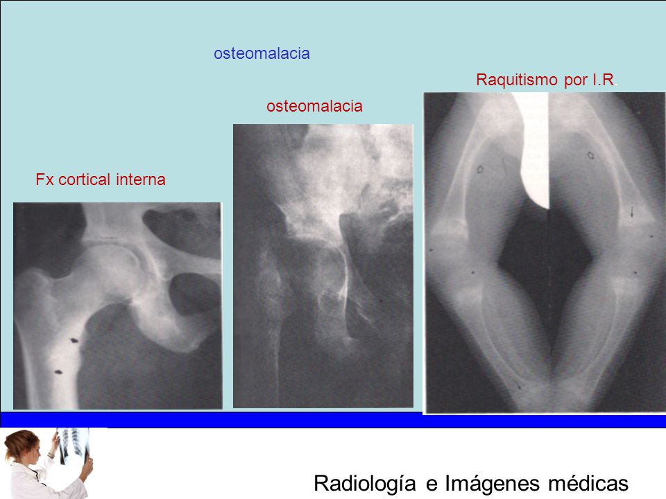 osteomalacia Raquitismo por I.R. osteomalacia Fx cortical interna