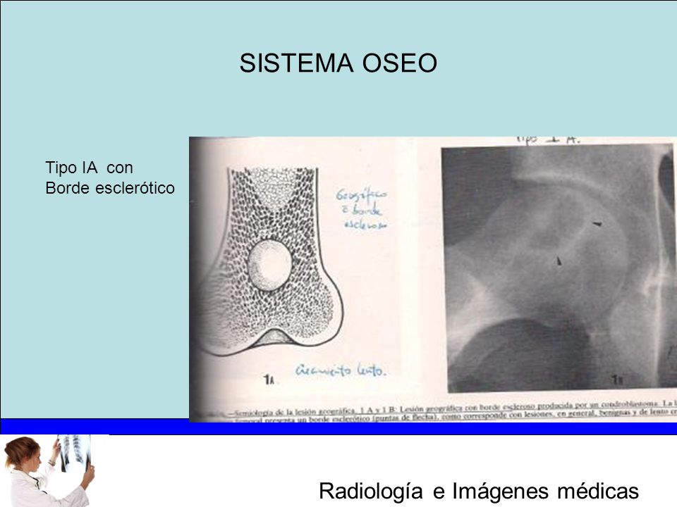 SISTEMA OSEO Tipo IA con Borde esclerótico