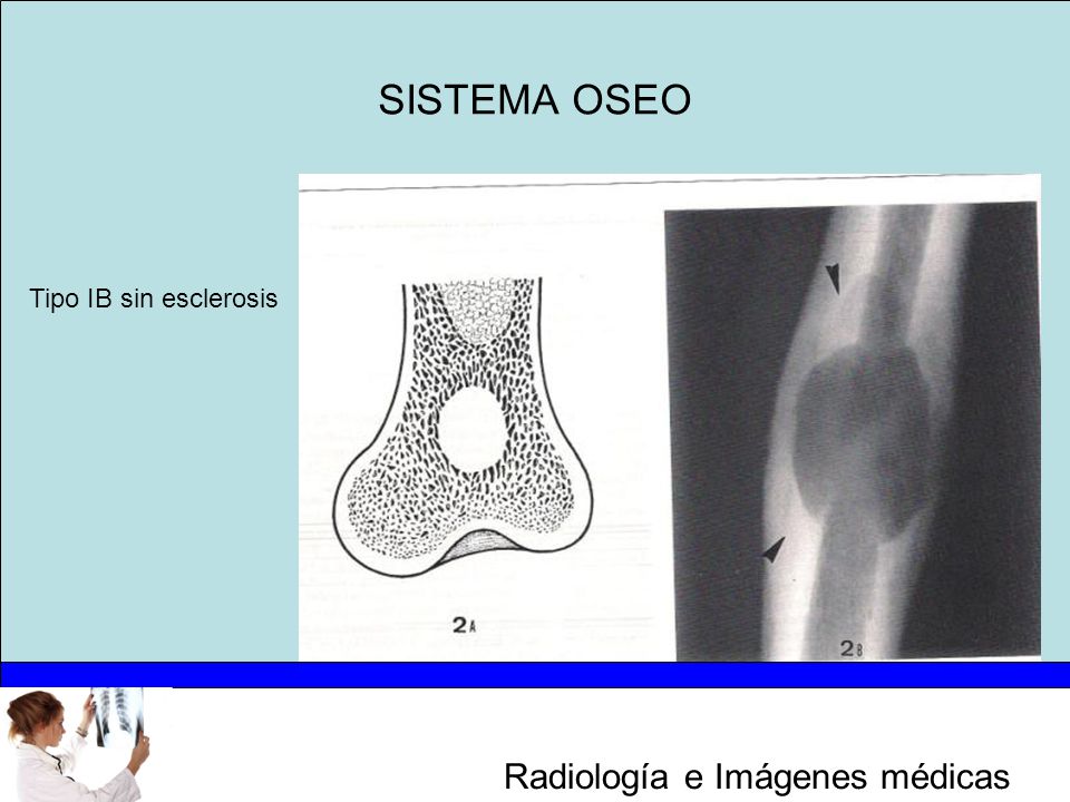 SISTEMA OSEO Tipo IB sin esclerosis