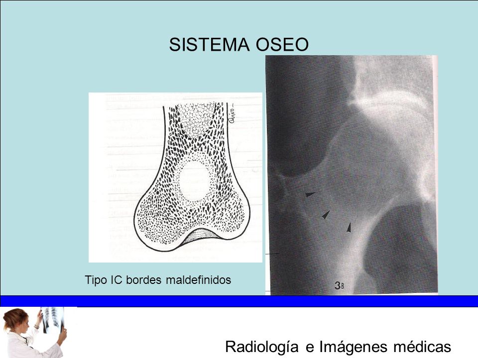 SISTEMA OSEO Tipo IC bordes maldefinidos
