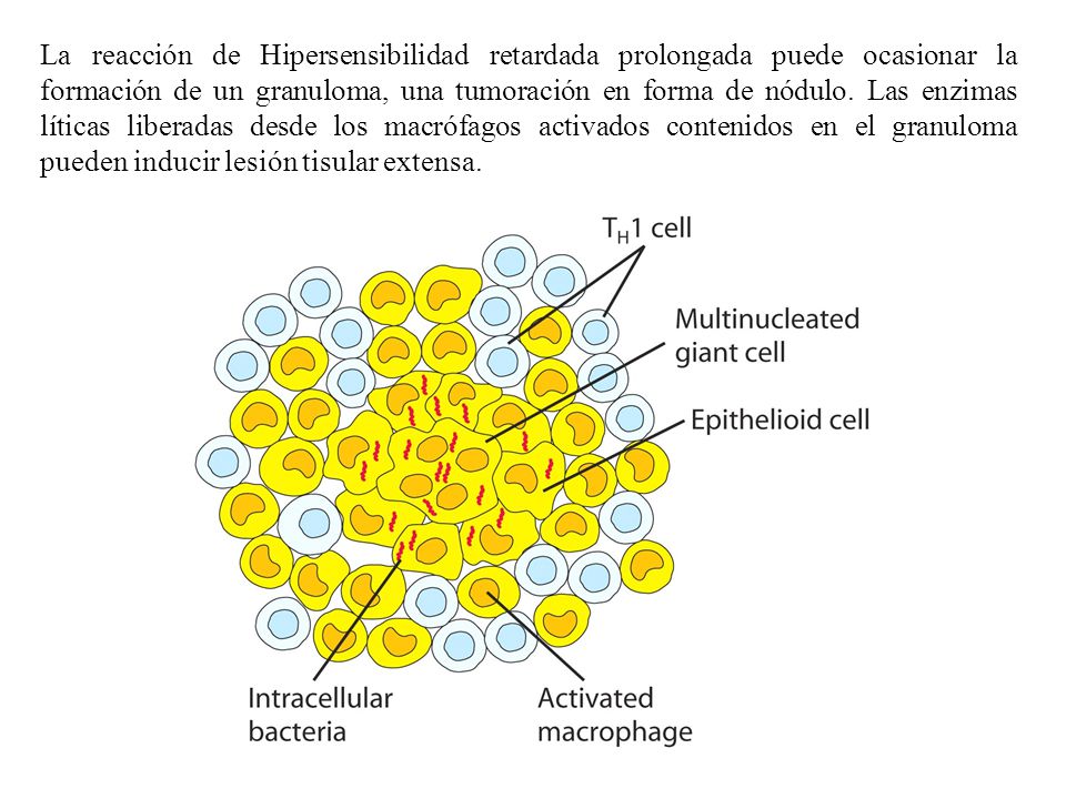 La reacción de Hipersensibilidad retardada prolongada puede ocasionar la formación de un granuloma, una tumoración en forma de nódulo.