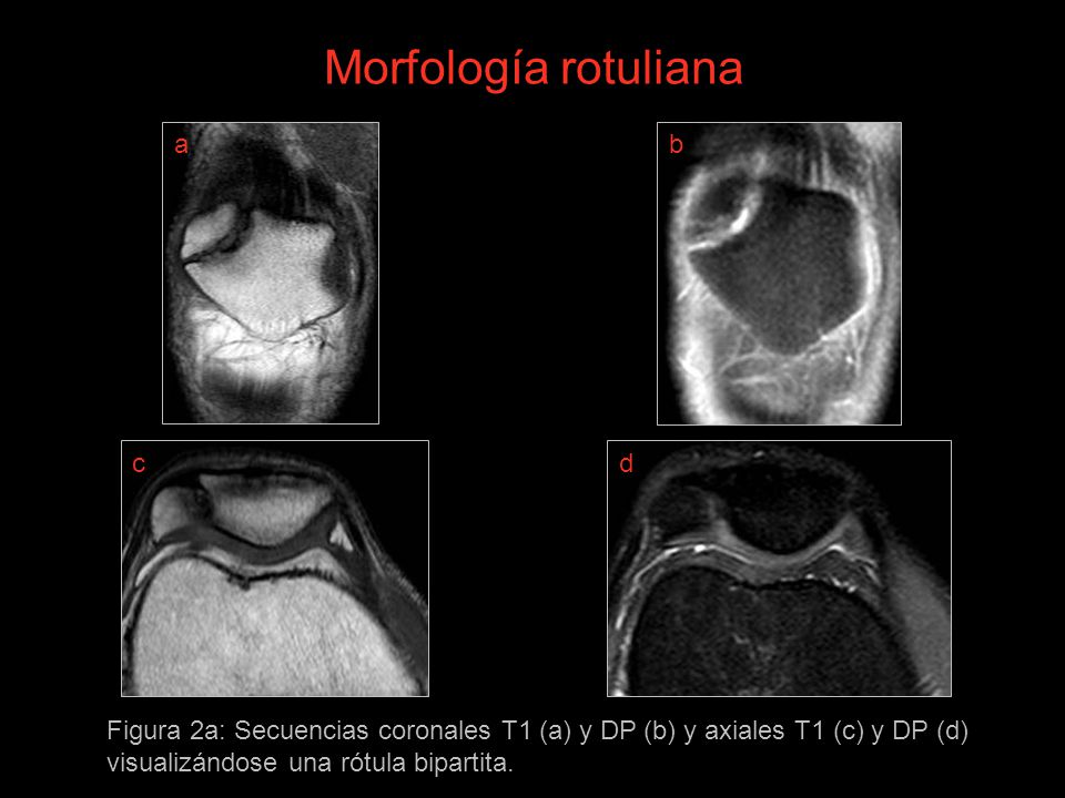 Morfología rotuliana a b c d
