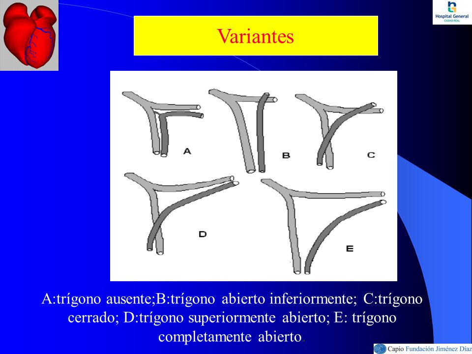 Variantes A:trígono ausente;B:trígono abierto inferiormente; C:trígono cerrado; D:trígono superiormente abierto; E: trígono completamente abierto.