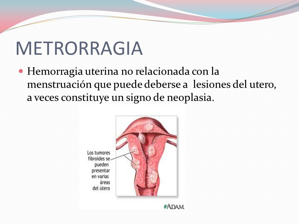 METRORRAGIA Hemorragia uterina no relacionada con la menstruación que puede deberse a lesiones del utero, a veces constituye un signo de neoplasia.
