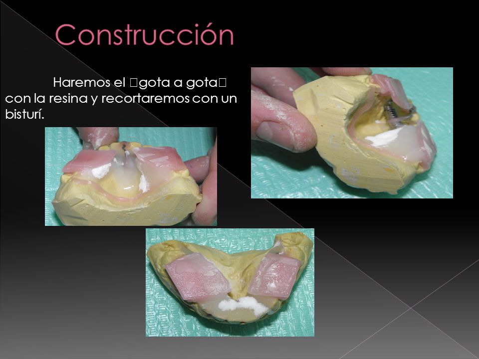 Construcción Haremos el gota a gota con la resina y recortaremos con un bisturí.