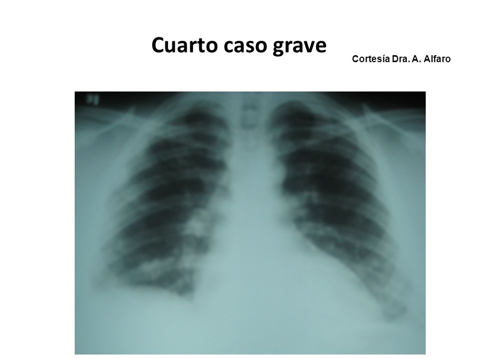 Cuarto caso grave Cortesía Dra. A. Alfaro