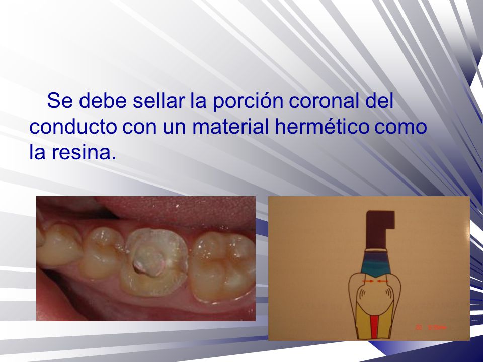 Se debe sellar la porción coronal del conducto con un material hermético como la resina.