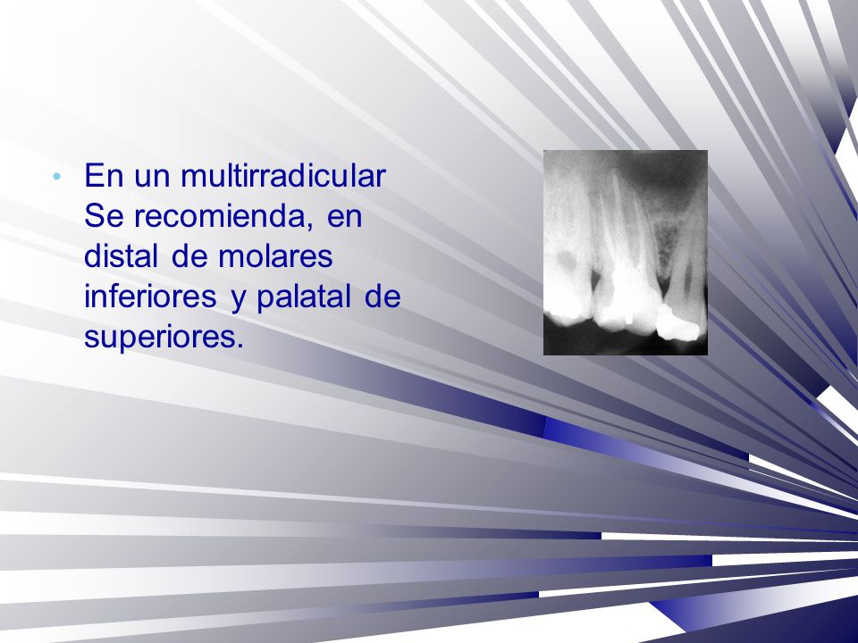 En un multirradicular Se recomienda, en distal de molares inferiores y palatal de superiores.