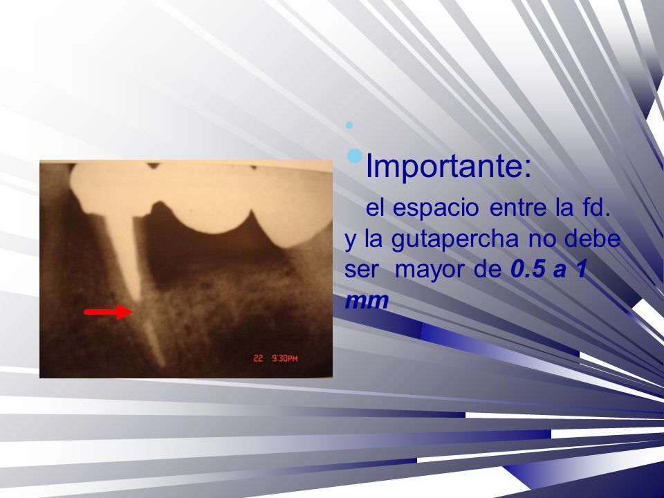 Importante: el espacio entre la fd. y la gutapercha no debe ser mayor de 0.5 a 1 mm *