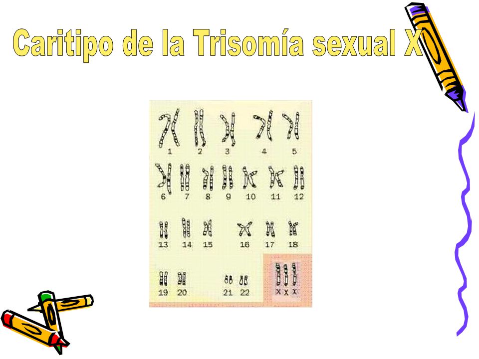 Caritipo de la Trisomía sexual X