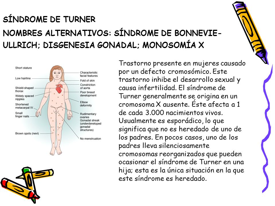 SÍNDROME DE TURNER NOMBRES ALTERNATIVOS: SÍNDROME DE BONNEVIE-ULLRICH; DISGENESIA GONADAL; MONOSOMÍA X