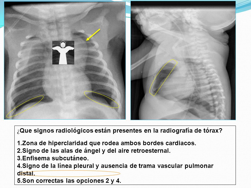 ¿Que signos radiológicos están presentes en la radiografía de tórax