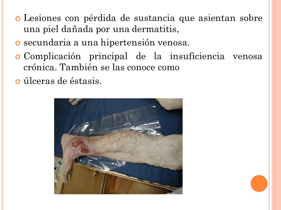 Lesiones con pérdida de sustancia que asientan sobre una piel dañada por una dermatitis,