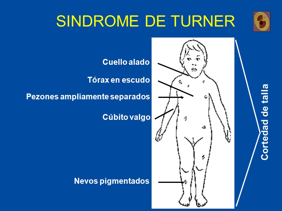 SINDROME DE TURNER Cortedad de talla Cuello alado Tórax en escudo