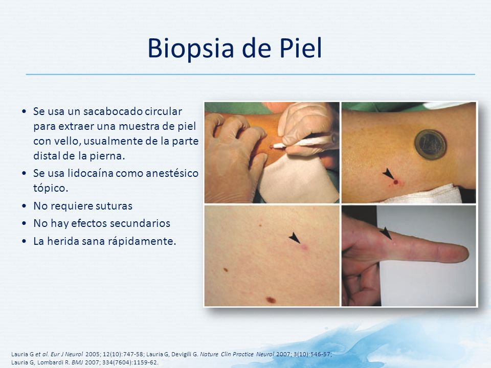 Biopsia de Piel Se usa un sacabocado circular para extraer una muestra de piel con vello, usualmente de la parte distal de la pierna.