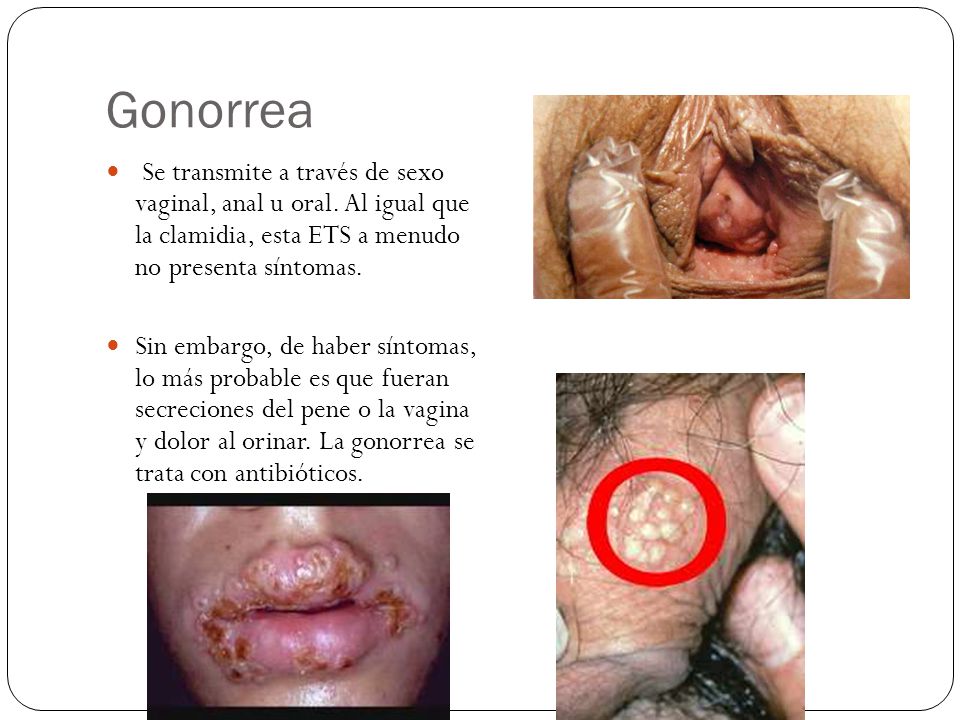 Gonorrea Se transmite a través de sexo vaginal, anal u oral. Al igual que la clamidia, esta ETS a menudo no presenta síntomas.