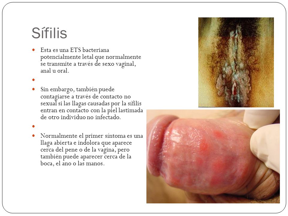 Sífilis Esta es una ETS bacteriana potencialmente letal que normalmente se transmite a través de sexo vaginal, anal u oral.