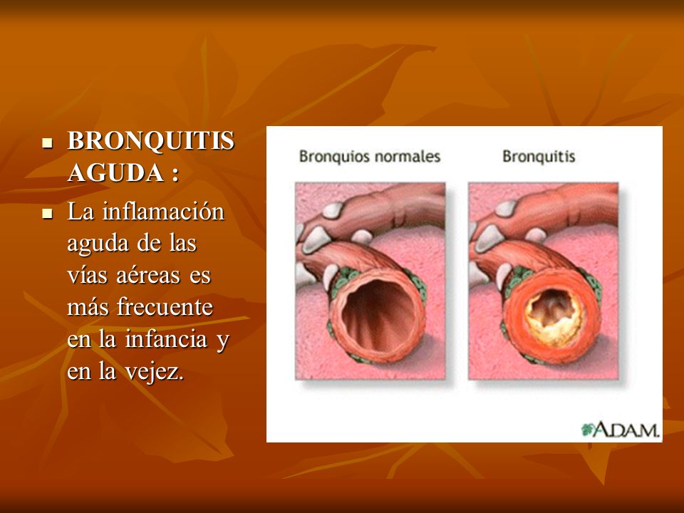 BRONQUITIS AGUDA : La inflamación aguda de las vías aéreas es más frecuente en la infancia y en la vejez.