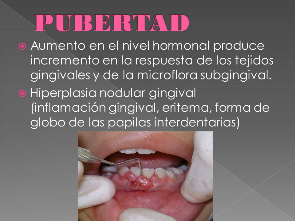 PUBERTAD Aumento en el nivel hormonal produce incremento en la respuesta de los tejidos gingivales y de la microflora subgingival.