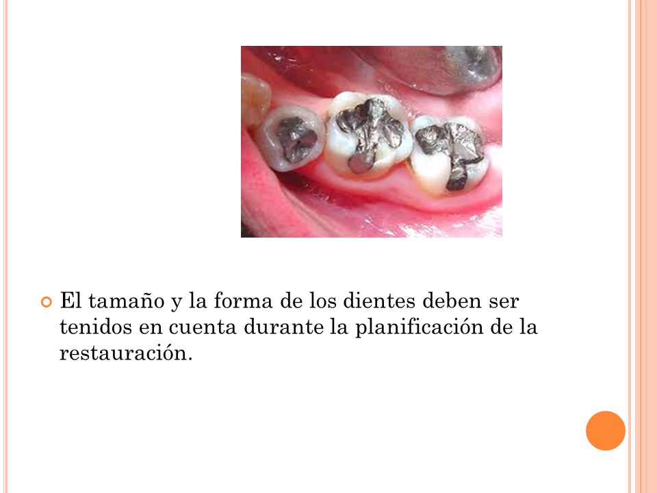 El tamaño y la forma de los dientes deben ser tenidos en cuenta durante la planificación de la restauración.