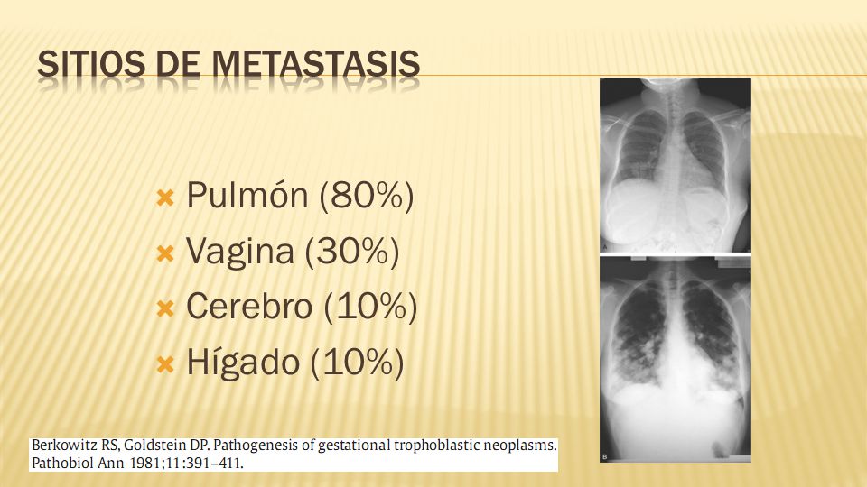 Sitios de metastasis Pulmón (80%) Vagina (30%) Cerebro (10%) Hígado (10%)