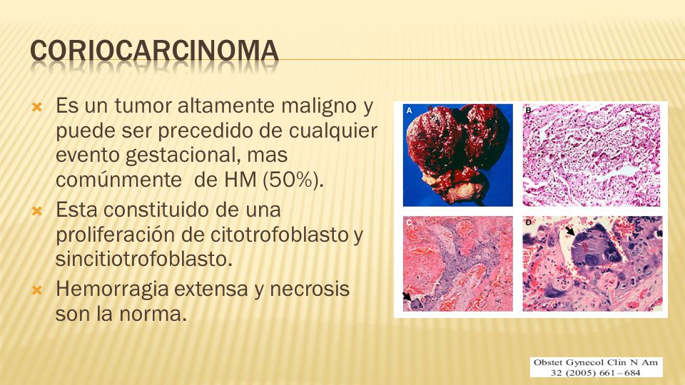 Coriocarcinoma Es un tumor altamente maligno y puede ser precedido de cualquier evento gestacional, mas comúnmente de HM (50%).