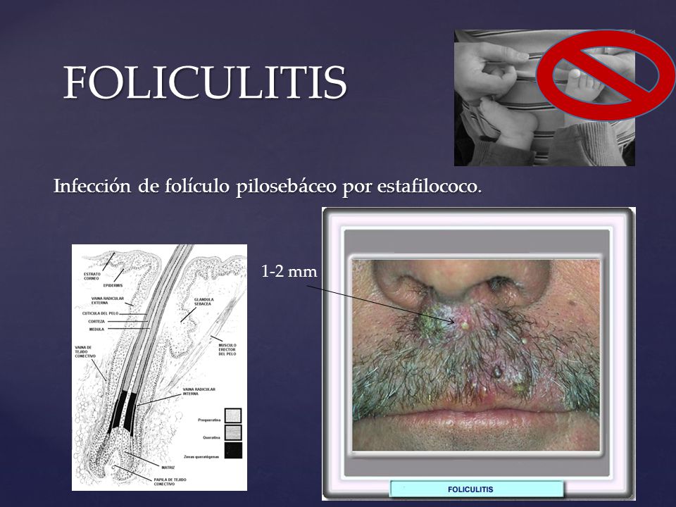 FOLICULITIS Infección de folículo pilosebáceo por estafilococo. 1-2 mm