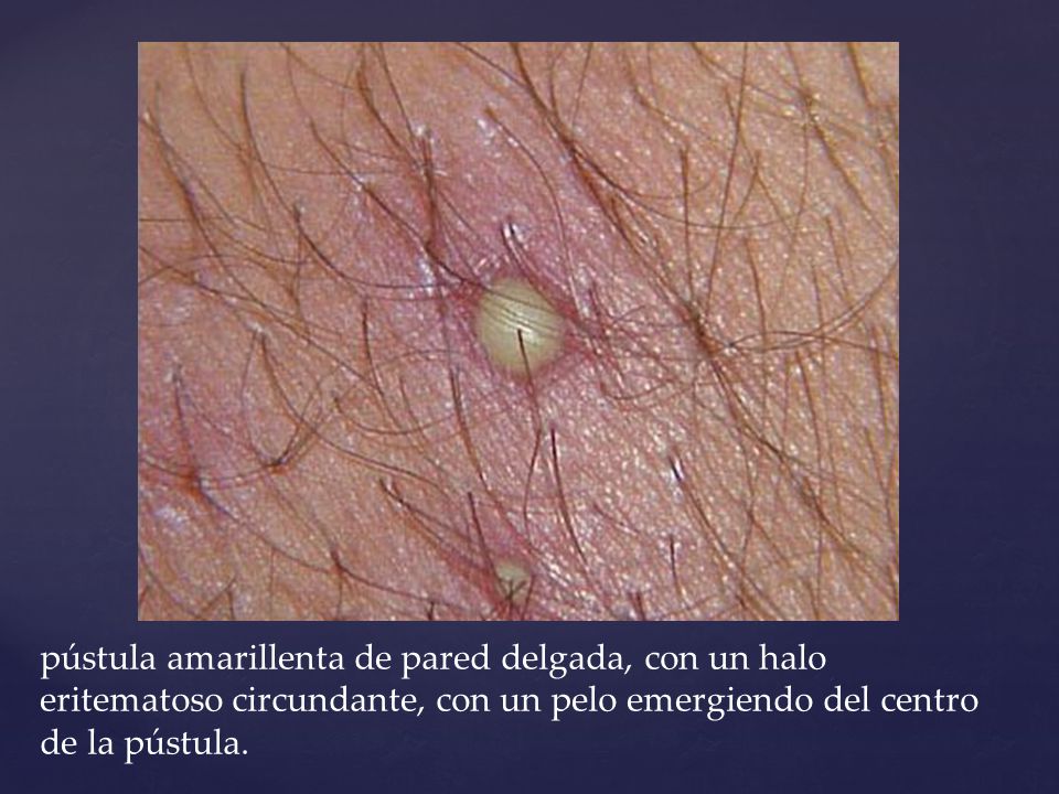 pústula amarillenta de pared delgada, con un halo eritematoso circundante, con un pelo emergiendo del centro de la pústula.