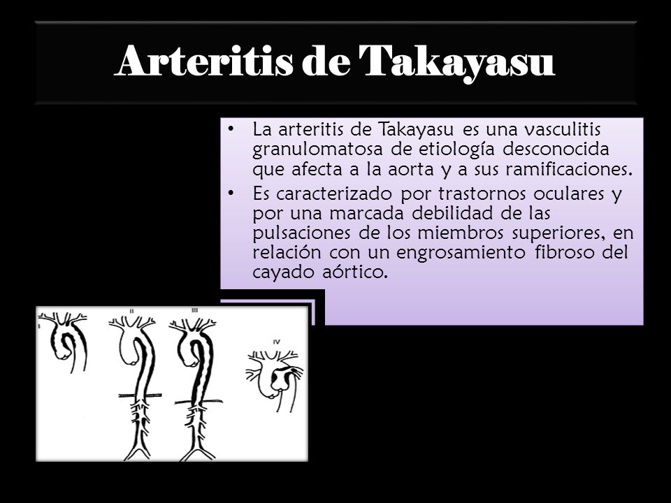 Arteritis de Takayasu La arteritis de Takayasu es una vasculitis granulomatosa de etiología desconocida que afecta a la aorta y a sus ramificaciones.